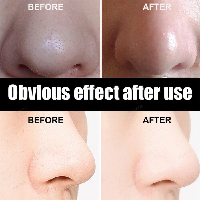 Unisex Blackhead Removal Mask - Image 3