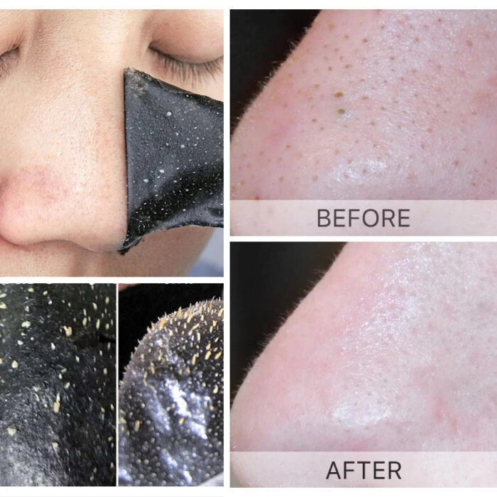 Unisex Blackhead Removal Mask - Image 6